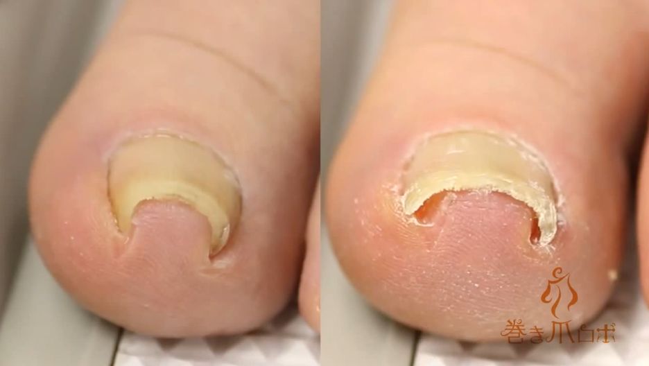 Nail Lifting (Onycholysis) in Adults: Condition ...
